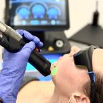 Laser ontharen gezicht
