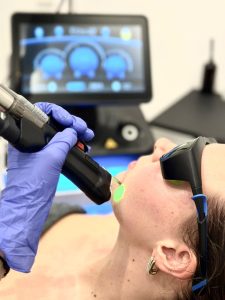 Laser ontharen gezicht