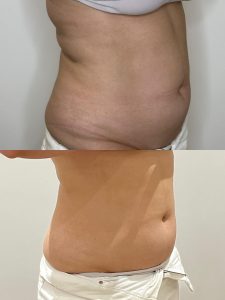 Vetbevriezen zonder liposuctie