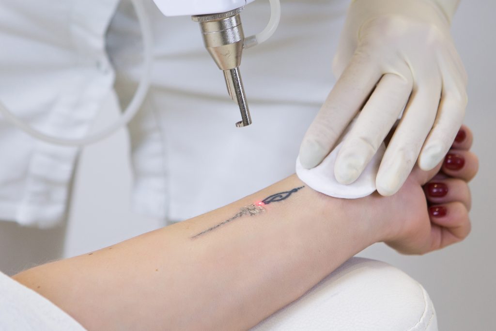Picolaser tattoo verwijderen bij Sophie Skincare in Voorburg