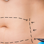 After Lipo massage Voorburg, Den Haag, Wassenaar, Leiden, Zoetermeer