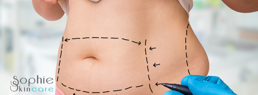 After Lipo massage Voorburg, Den Haag, Wassenaar, Leiden, Zoetermeer