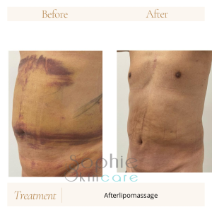 Lymfedranaige na liposuctie met afterlipomassage bij Sophie Skincare Voorburg/ Den Haag