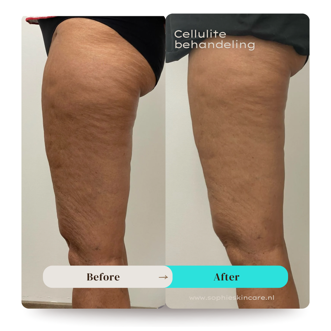 Voor en na: LPG Endermologie bij cellulite
