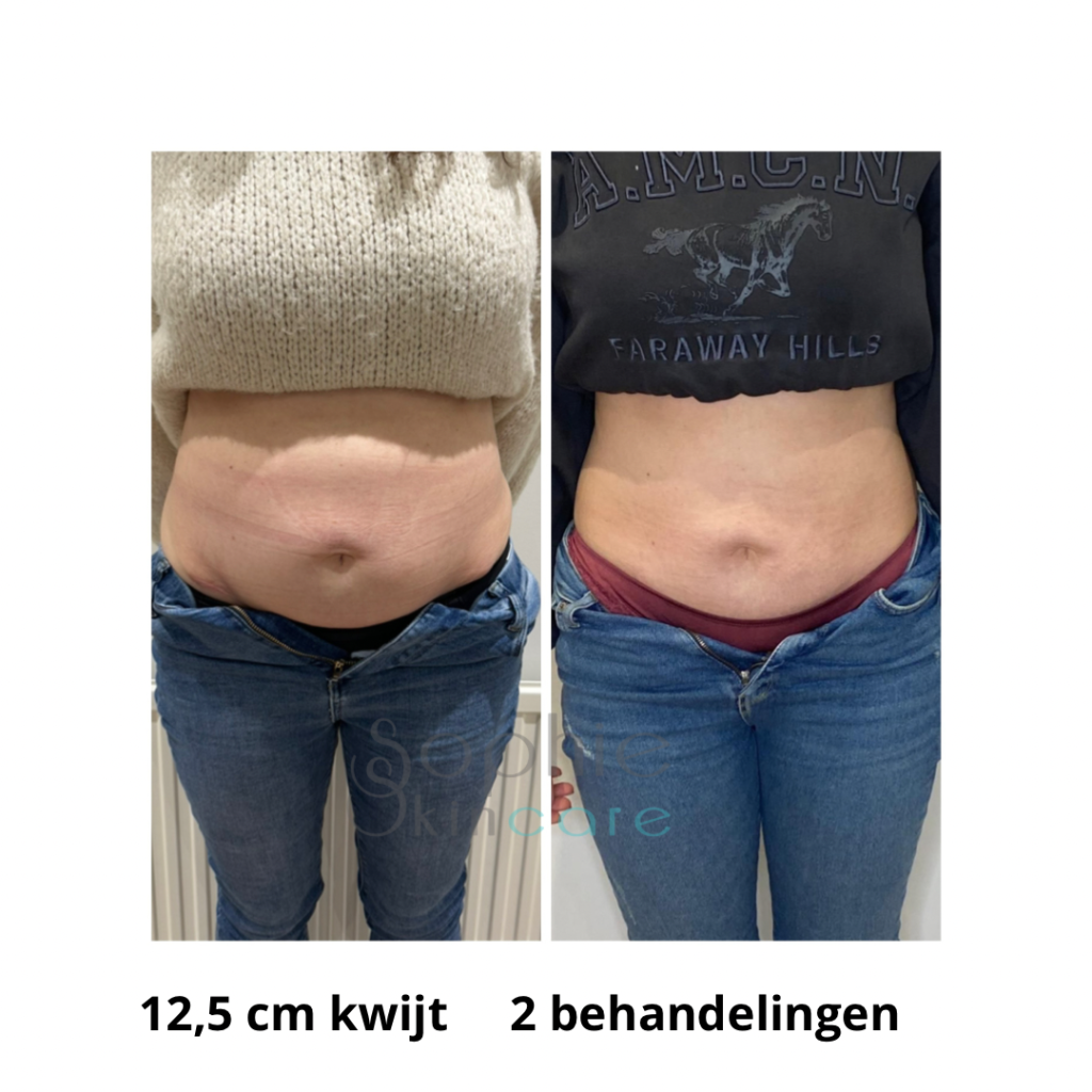 Behandeling buikvet verliezen zonder operatie