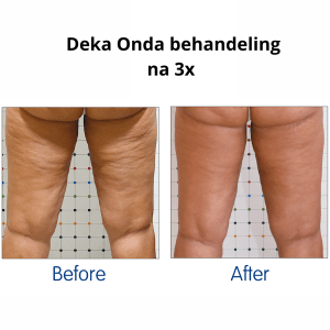 Cellulite benen verwijderen in Den Haag