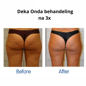 Cellulite behandeling | Bindweefselbehandeling Voorburg bij Sophie Skincare in Voorburg