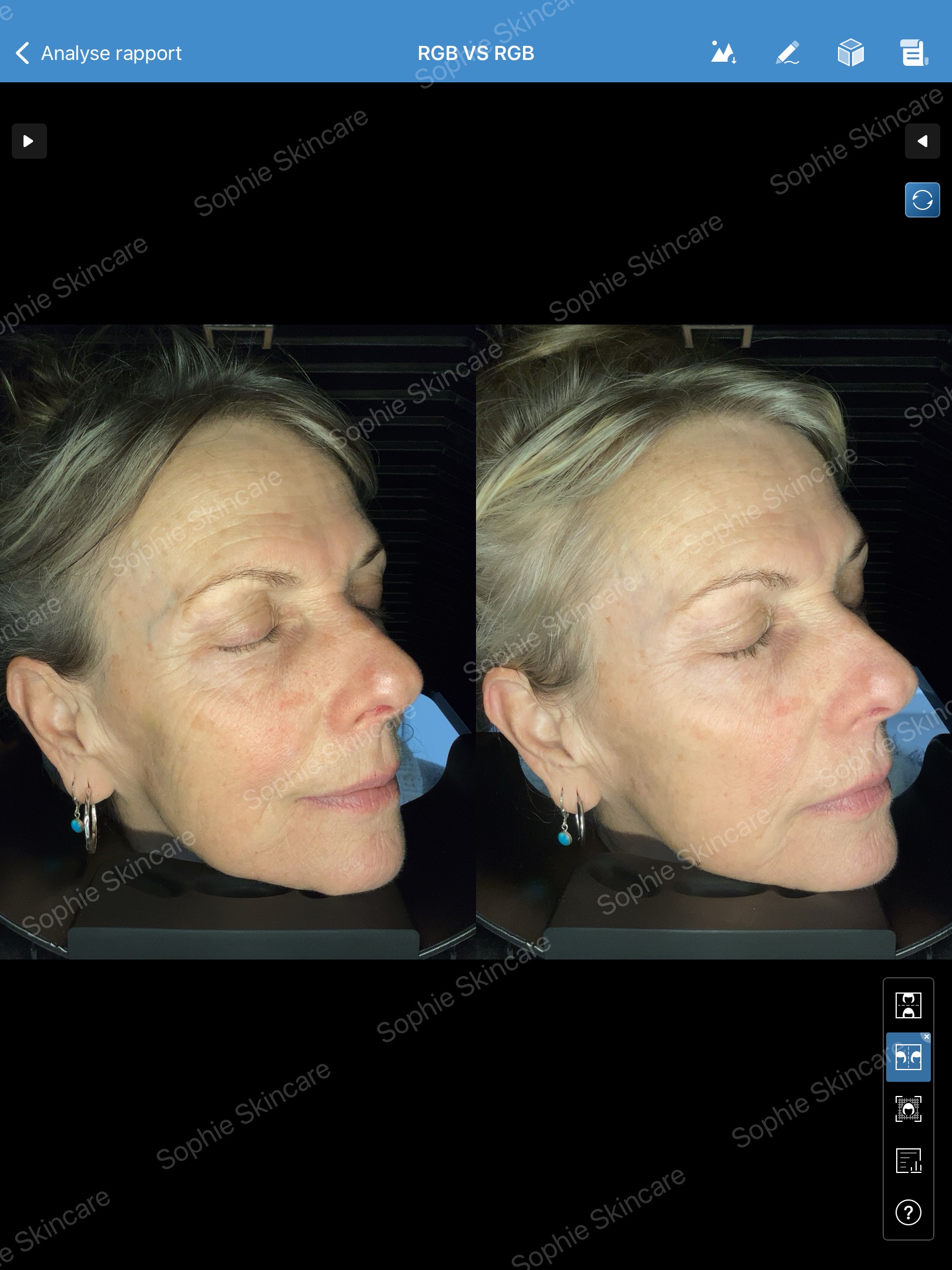 Resultaat PicoFilling behandeling met zichtbaar liftend effect bij wangen en rondom de mond