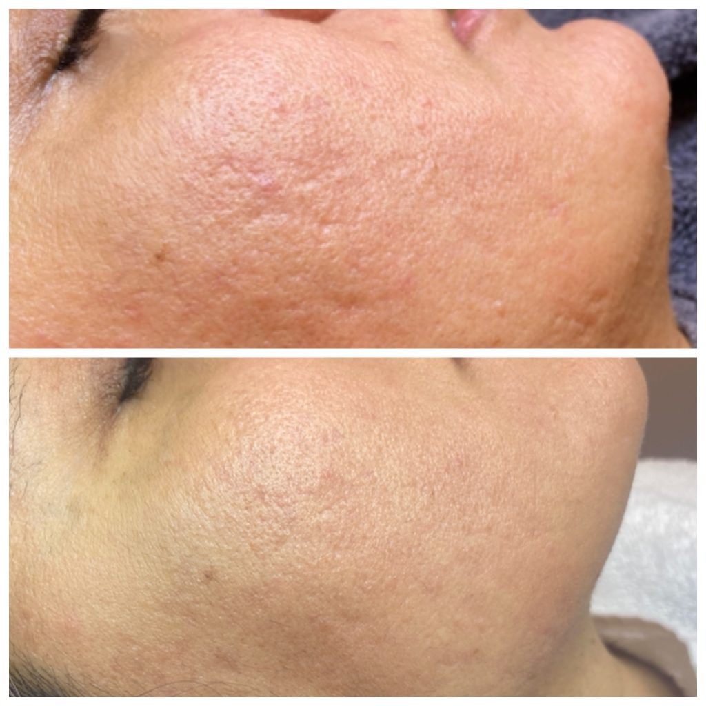 Dermapen behandeling Den Haag