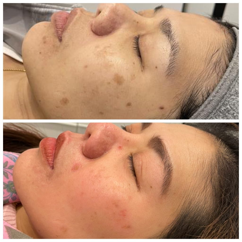 Cosmelan en Dermelan behandeling bij Sophie Skincare huidkliniek in Voorburg