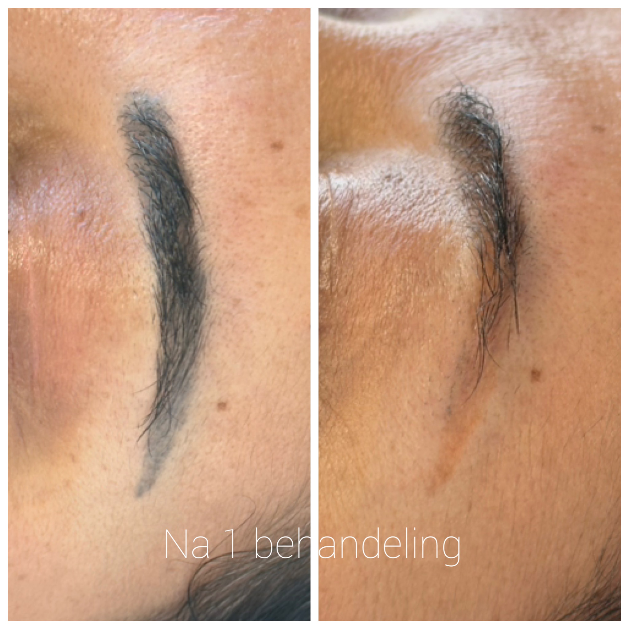 Resultaat PMU verwijdering wenkbrauwen na 1 behandeling Sophie Skincare Voorburg