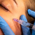 Skinbooster behandeling tegen rimpels en huidverslapping