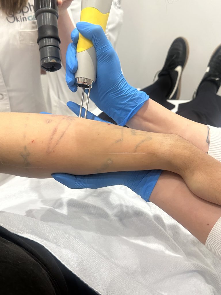Tattoo verwijderen met picolaser bij Sophie Skincare Den Haag