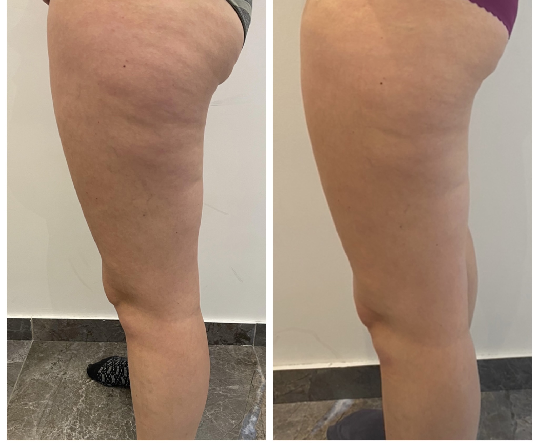 Voor en na resultaat lymfedrainage met LPG Endermologie bij vochtophoping en cellulite in de benen — strakker en gladder huidbeeld na behandeling bij Sophie Skincare Voorburg