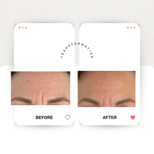 Seinbooster behandeling Huidtherapie Sophie Skincare