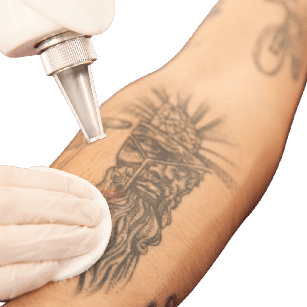 Tattoo en oude permanente make up verwijderen met laser bij huidkliniek Sophie Skincare in Vooburg