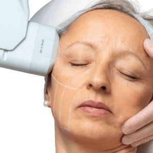 Hifu behandeling Den Haag bij Sophie Skincare