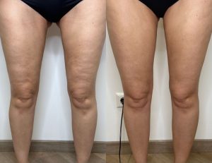 LPG Endermoligie voor en nafoto's bij Sophie Skincare in Voorburg