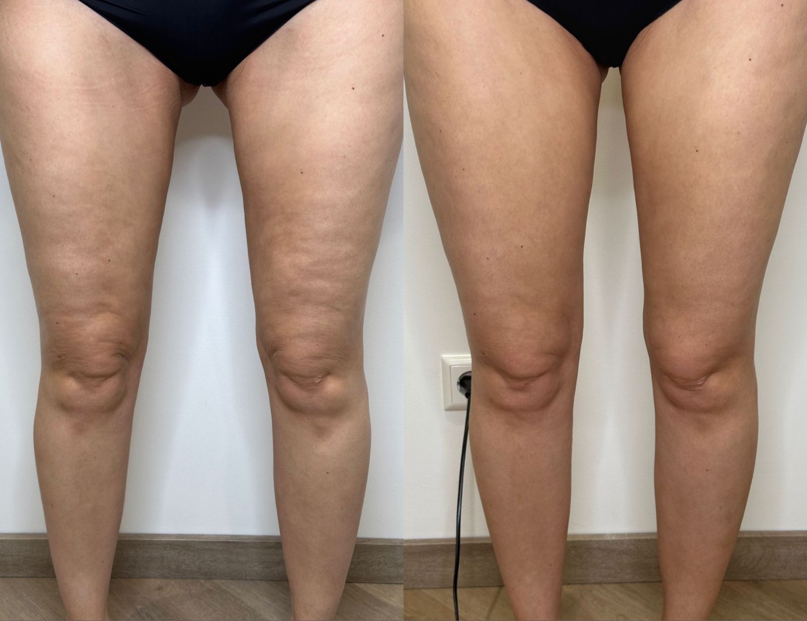 LPG Endermoligie voor en nafoto's bij Sophie Skincare in Voorburg