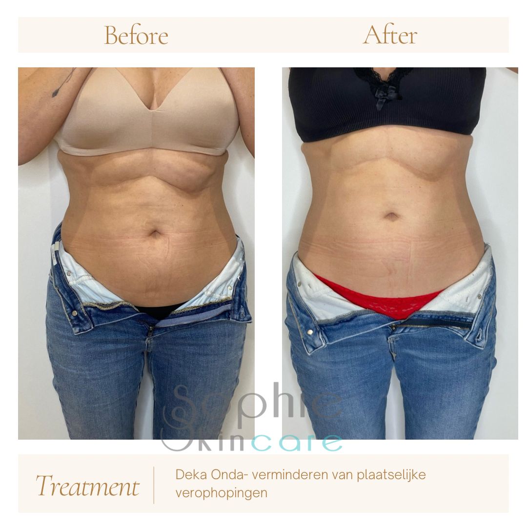 Voor en na: Deka Onda Coolwaves