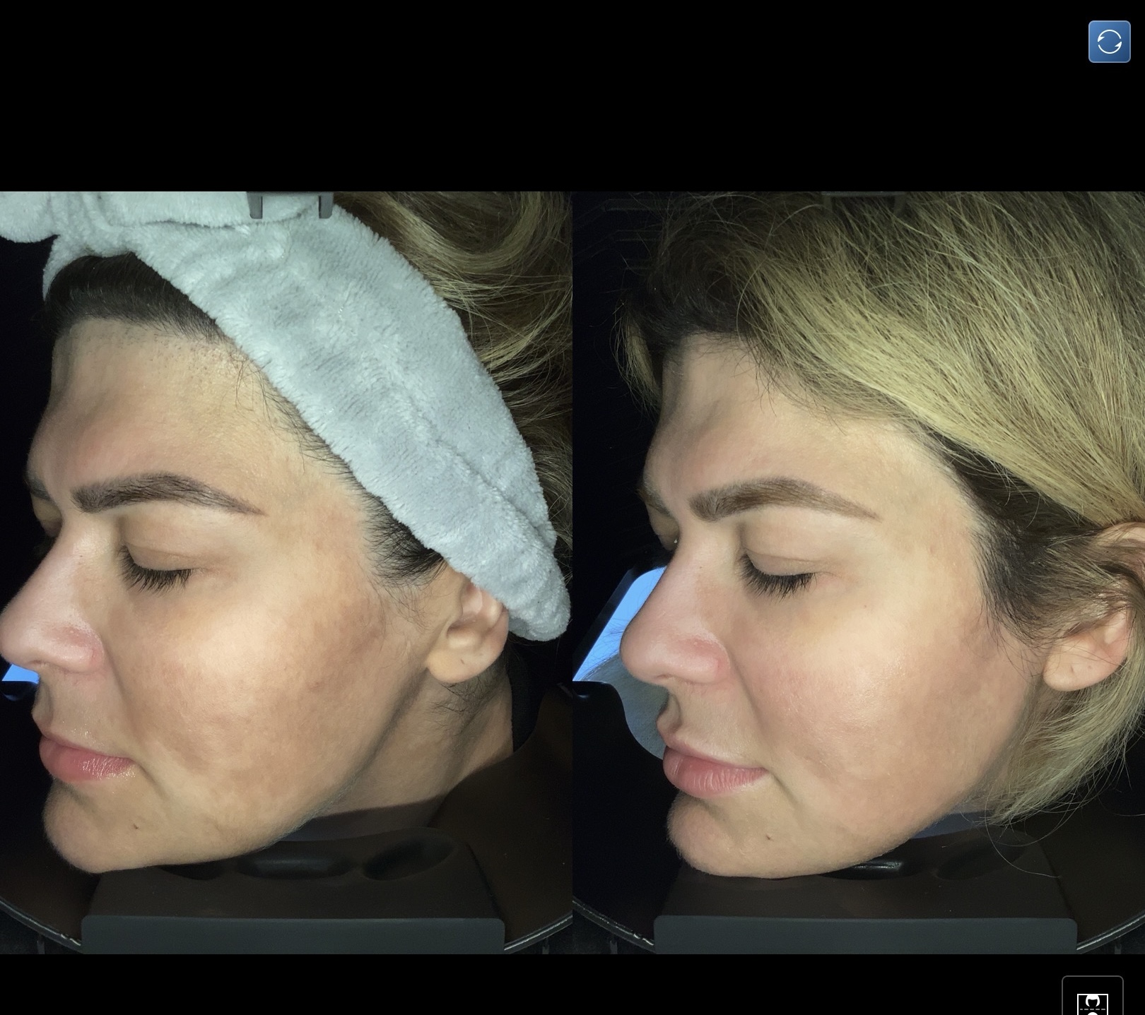 Resultaat pigmentbehandeling bij Sophie Skincare Voorburg