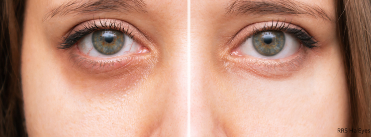 RRS HA eyes voor en na foto