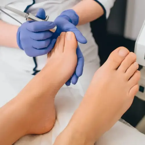 Schimmelnagels laseren