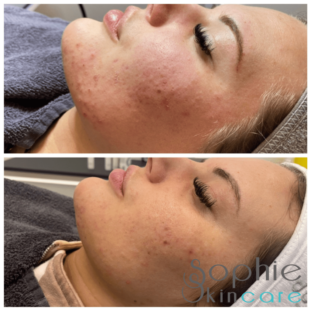 hormonale puistjes behandeling, hoe kom ik van acne af