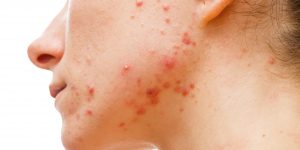 acne behandeling vergoedt door zorgverzekering