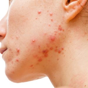 acne behandeling vergoedt door zorgverzekering