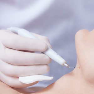 Coagulatie bij Sophie Skincare in Voorburg