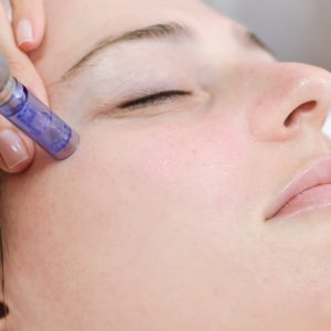 Dermapen behandeling bij Sophie Skincare in Voorburg