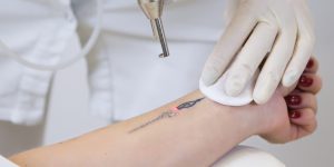 Picolaser tattoo verwijderen