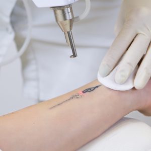 Picolaser tattoo verwijderen bij Sophie Skincare in Voorburg