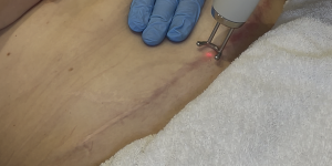 Littekenbehandeling voor het verwijderen van acne littekens