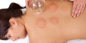 Cupping bij Sophie Skincare in Voorburg