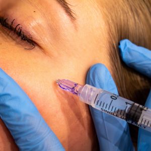 Skinbooster behandeling tegen rimpels en huidverslapping