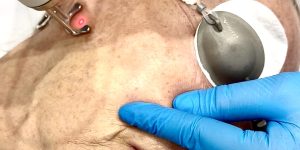 Een liftende laserbehandeling om volume in het gezicht te herstellen bij Sophie Skincare in Voorburg