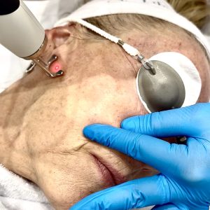 Een liftende laserbehandeling om volume in het gezicht te herstellen bij Sophie Skincare in Voorburg