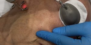 Een liftende laserbehandeling om volume in het gezicht te herstellen bij Sophie Skincare in Voorburg
