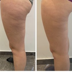 Cellulitis behandeling Sophie Skincare VOORBURG