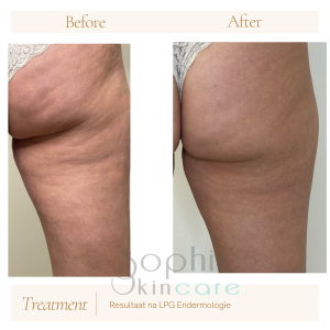 Resultaat LPG Endermolgie bij Sophie Skincare