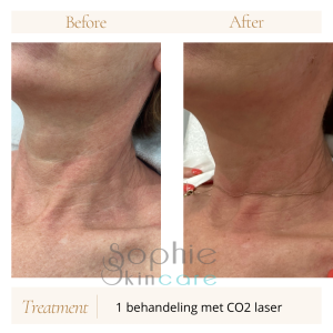 Co2 laserbehandeling voor de hals