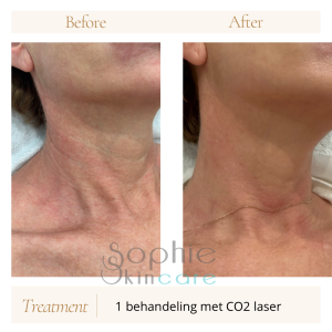Verstakking van de hals met Co2 laserbehandeling