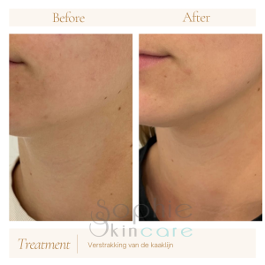 Hifu behandeling bij Sophie Skincare in Voorburg en omgeving Den Haag voor een natuurlijke facelift