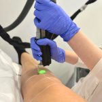 laser ontharen benen in Den Haag Sophie Skincare Huidtherapie