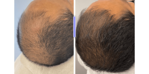 Haargroei behandeling voor mannen en vrouwen