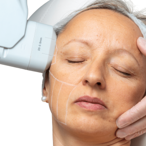 Hifu behandeling Den Haag bij Sophie Skincare