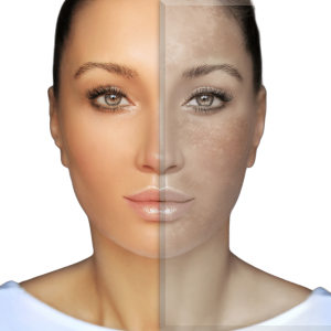 Melasma behandeling bij huidtherapie kliniek Sophie Skincare in Voorburg