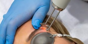 PMU verwijderen met laser in Voorburg/ Den Haag